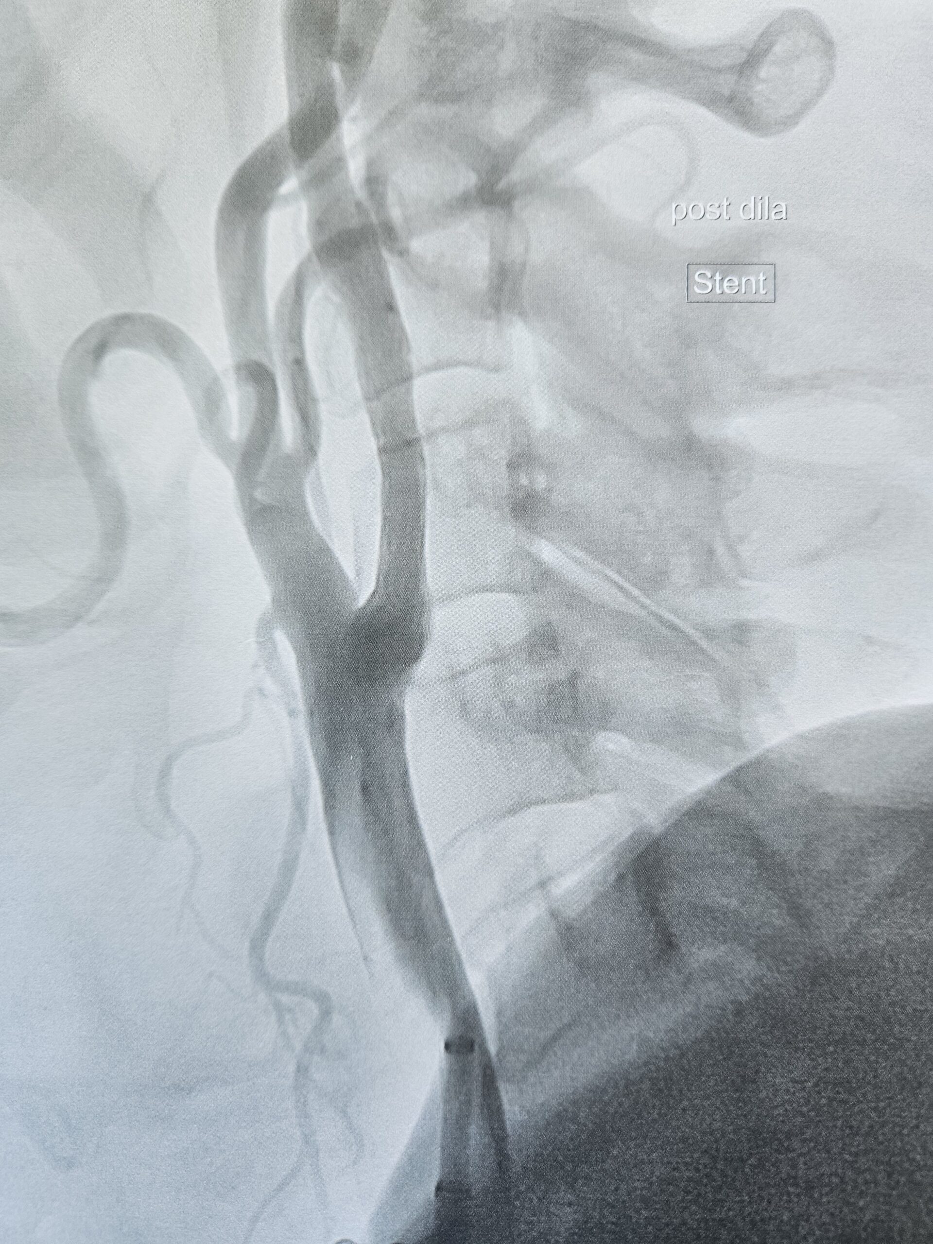 after-stent-placement
