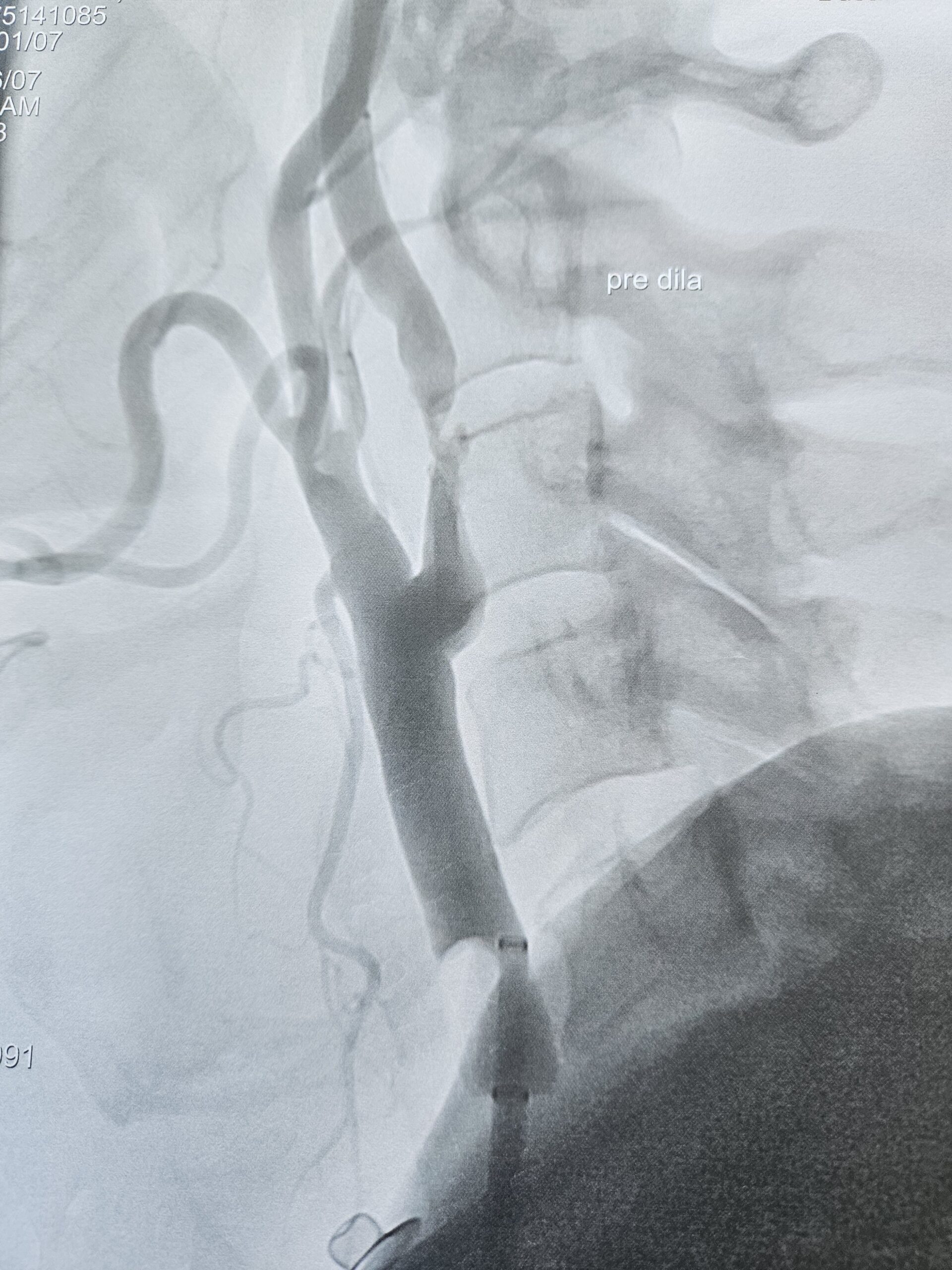 before-stent-placement