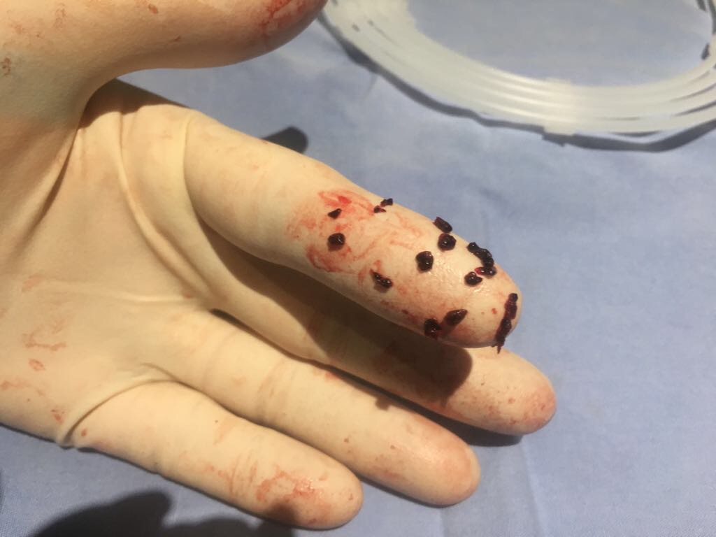 stroke-clot-image